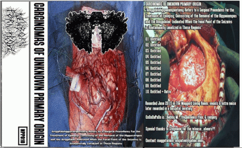 Carcinomas Of Unknown Primary Origin : Amygdalohippocampectomy Refers to a Surgical Procedures for the Treatment of Epilepsy, Consisting of